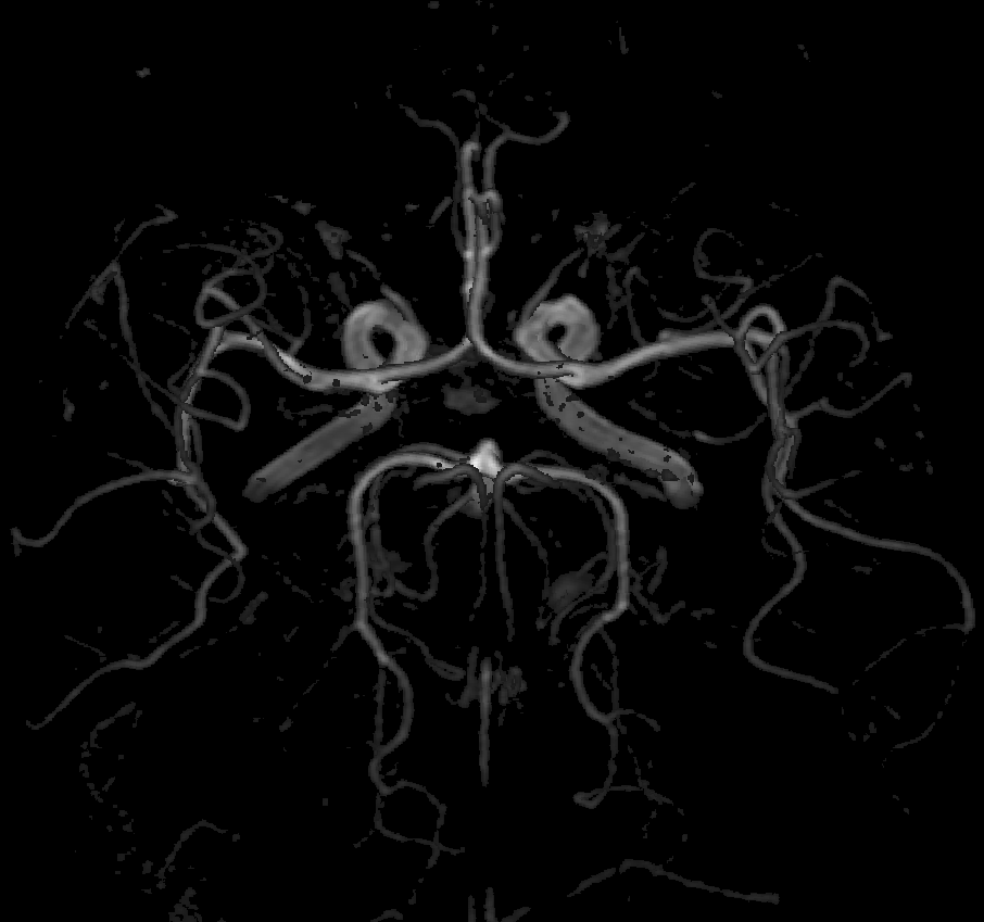 Closest Vessel Projection from MRA images taken of human head